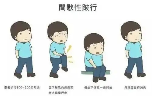 下肢动脉硬化闭塞间隙性跛行.webp